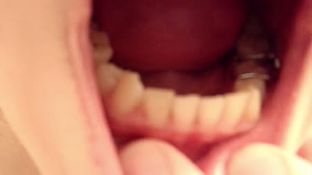 I Need Some Dental Work - I need some dental work... In this clip I show you my cavities, gaps between my molars, and my permanent metal spacers.